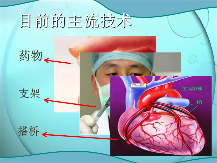 比较血管“搭桥”和“支架”手术的利弊文档资料.ppt_第2页