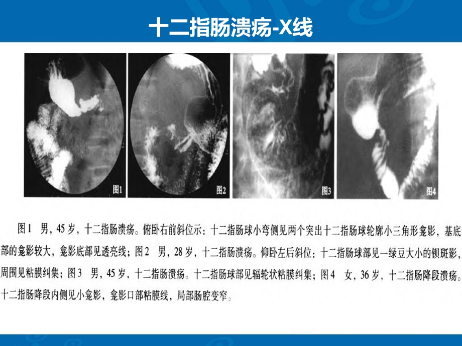 十二指肠常见病变影像诊断文档资料.ppt_第3页