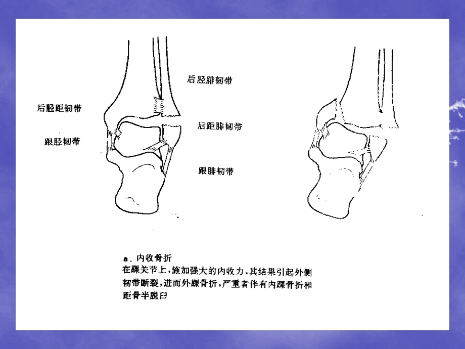 内踝骨折文档资料.ppt_第2页