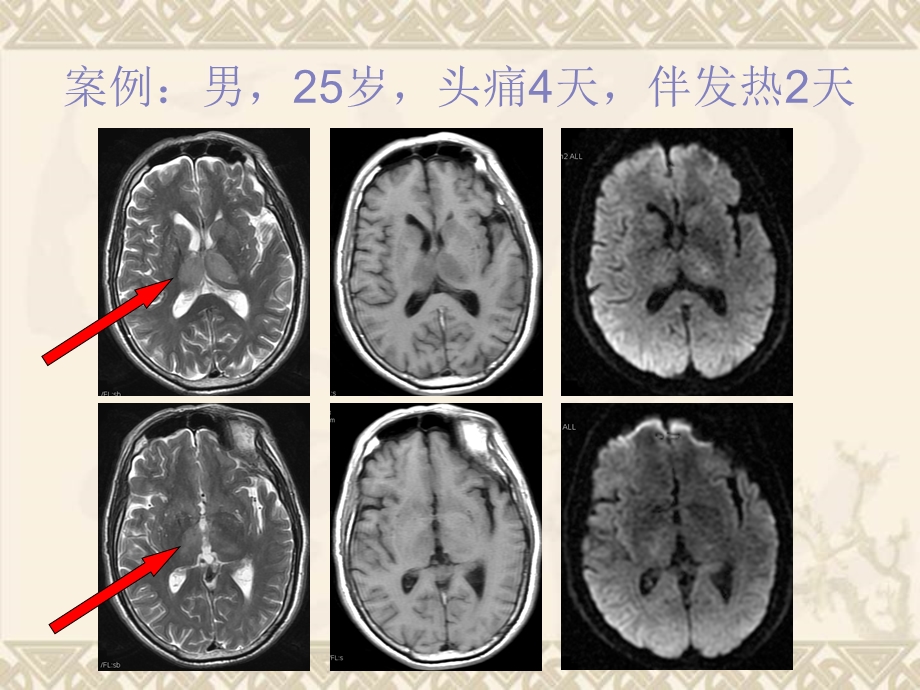 大脑内静脉及其属支的MRV成像研究.ppt_第2页