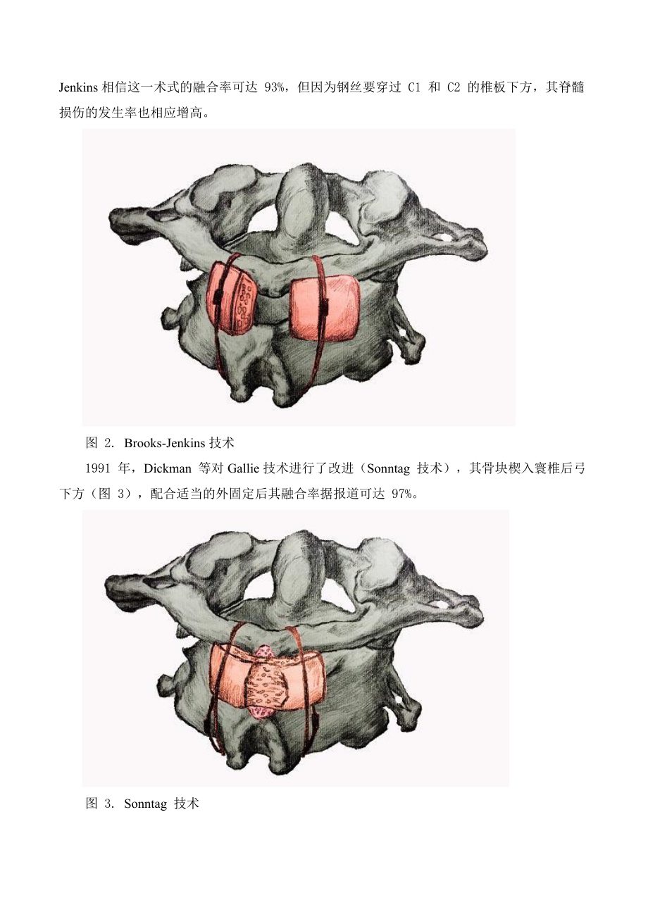 寰枢椎后路内固定术大汇总情况.doc_第2页