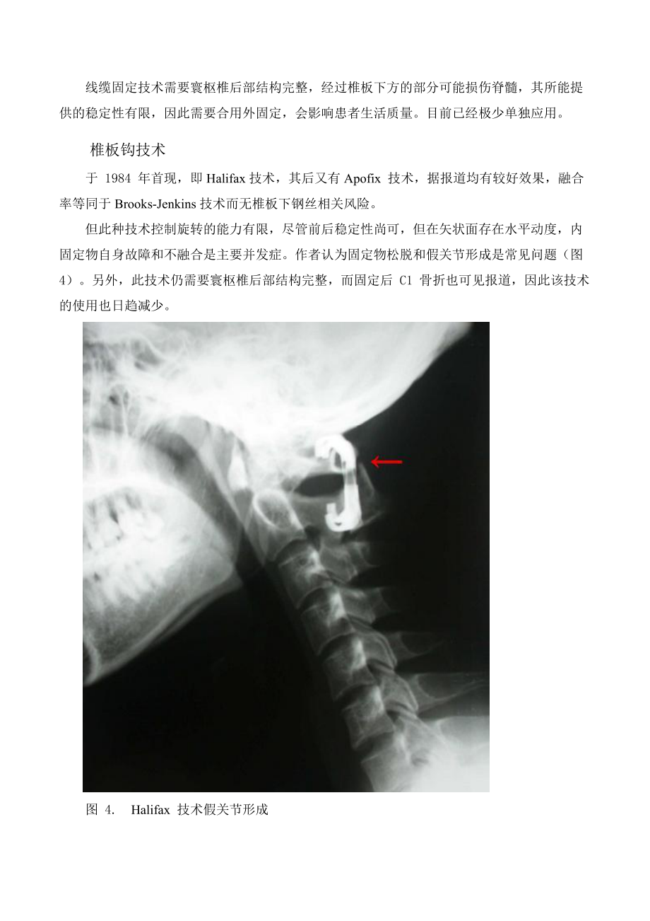 寰枢椎后路内固定术大汇总情况.doc_第3页