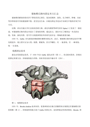 寰枢椎后路内固定术大汇总情况.doc