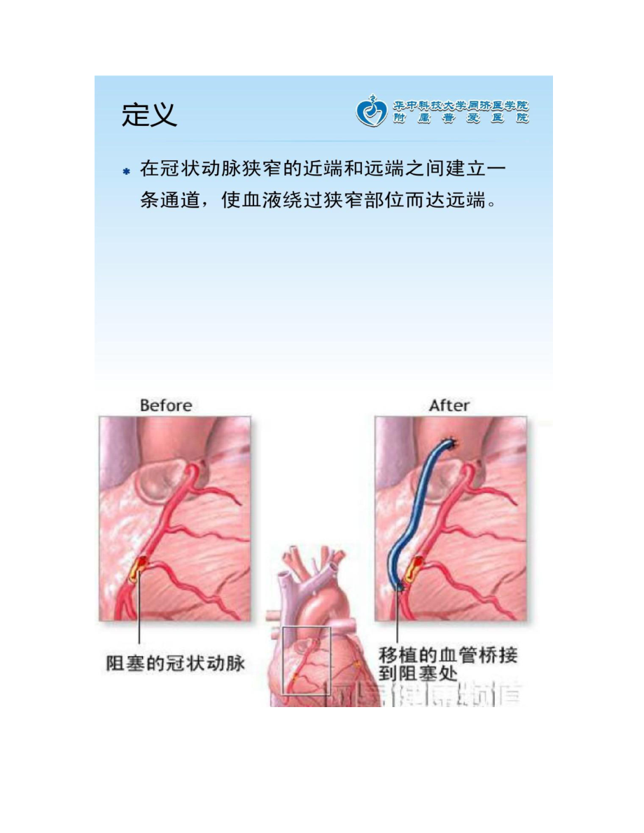 冠脉搭桥术后护理-汇总.doc_第3页