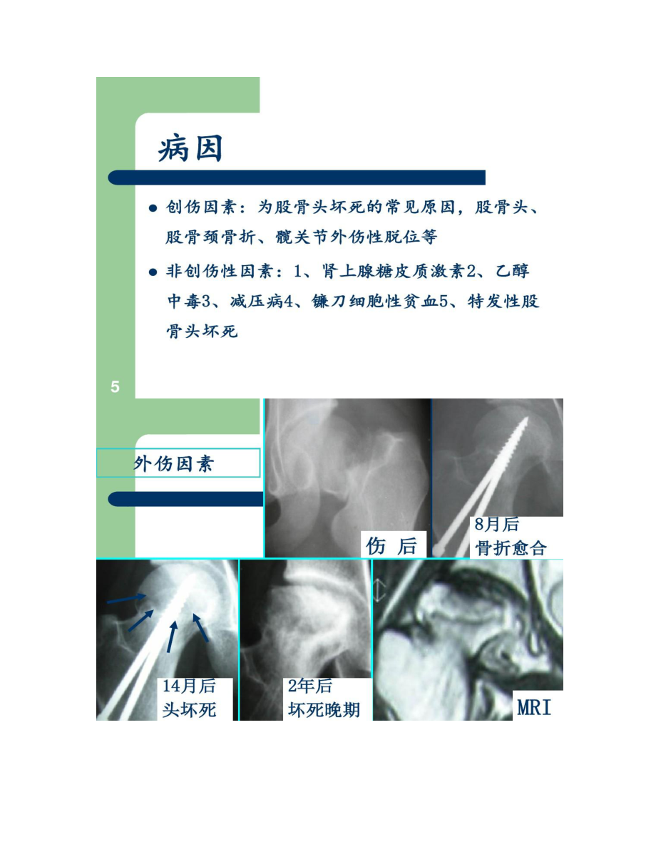 外科学第八版股骨头坏死课件.doc_第3页