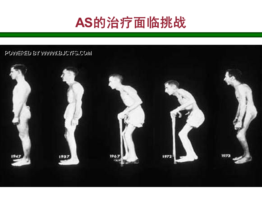 医学课件益赛普治疗强直性脊柱炎.ppt_第2页