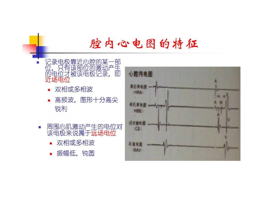 腔内心电图.ppt.ppt_第3页