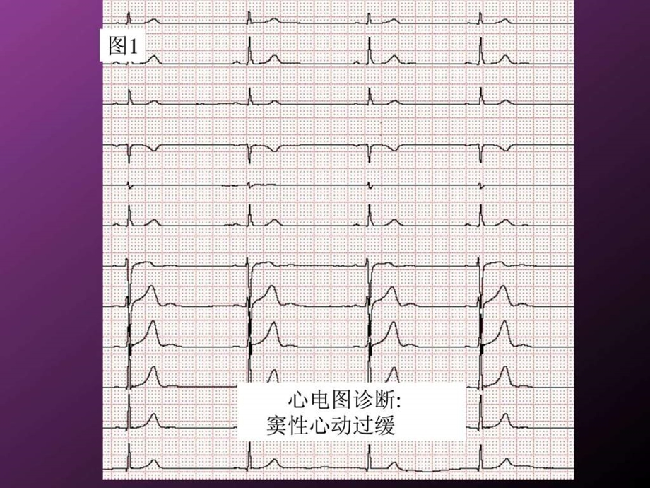 专培教案心电图识图.ppt.ppt_第2页