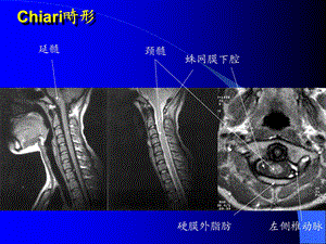 头部CT诊断.ppt