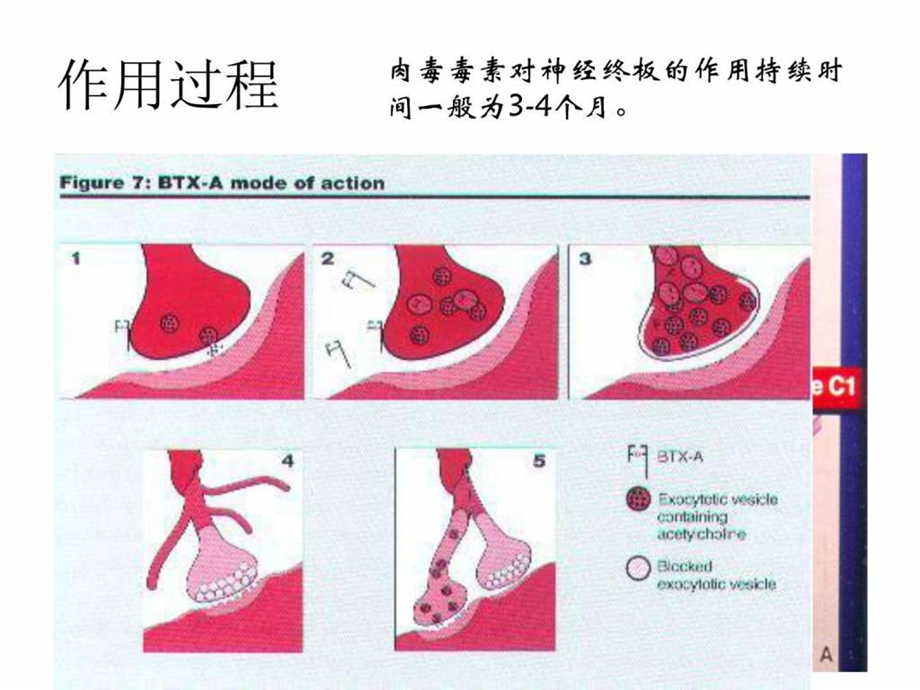 肉毒素注射图文.ppt.ppt_第3页