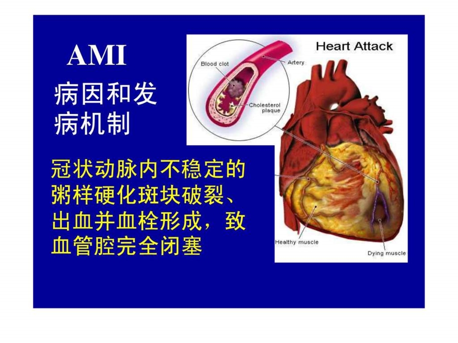 AMI的诊断.ppt.ppt_第3页