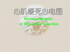 心肌梗死心电图心脏内科ppt课件.ppt.ppt