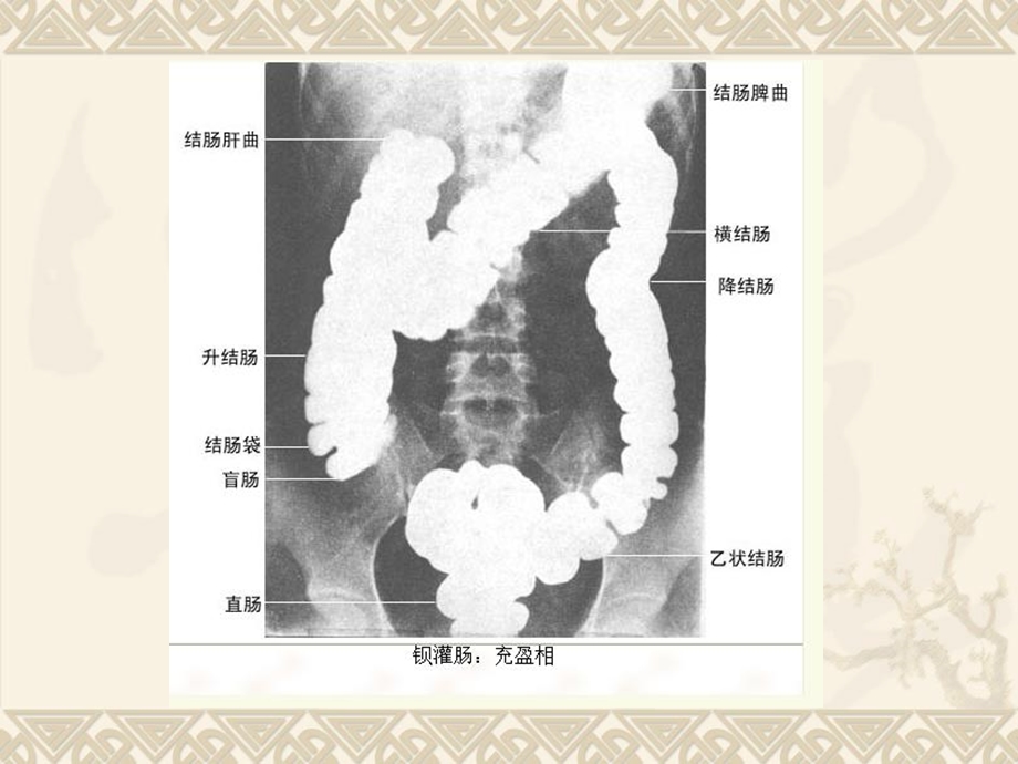 医学影像学第七版肠道系统.ppt_第3页