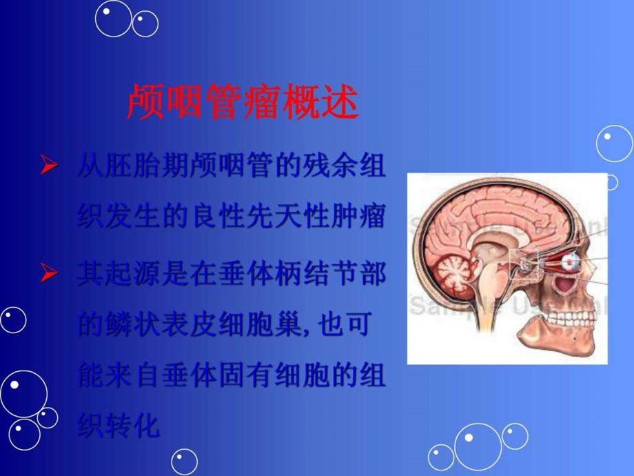 颅咽管瘤.张.ppt.ppt_第3页