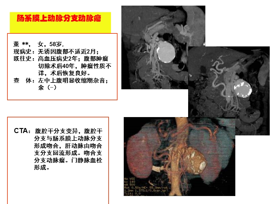 慢性肠系膜上动脉疾病的治疗策略.ppt_第2页