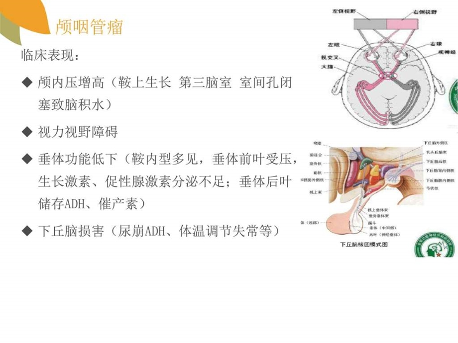 颅咽管瘤图文.ppt.ppt_第3页