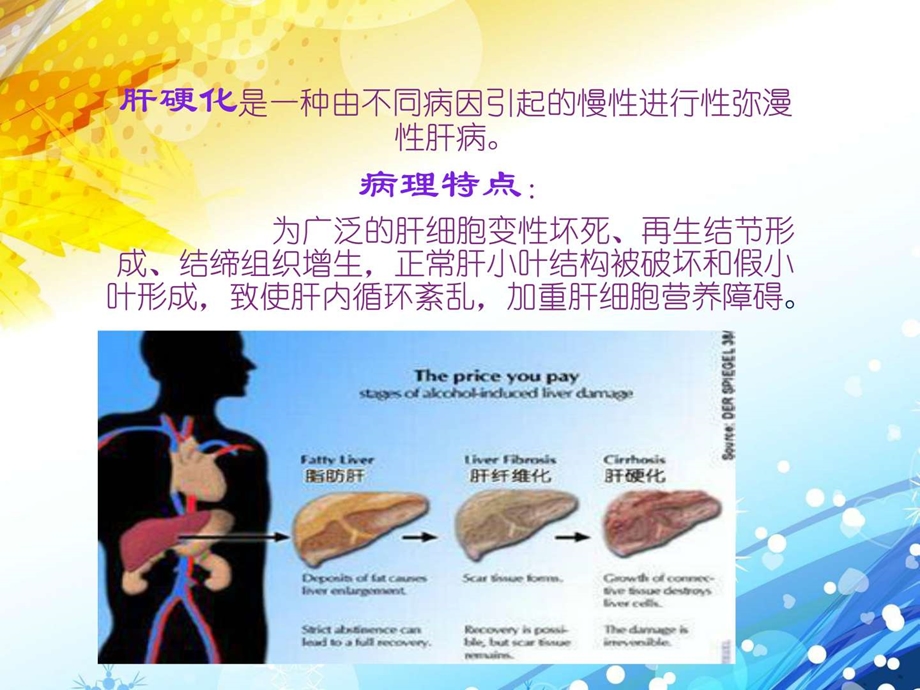 肝硬化失代偿期治疗护理图文.ppt_第2页