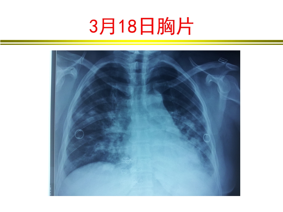 病例汇报一例H7N9流感病毒感染患者的救治.ppt_第3页