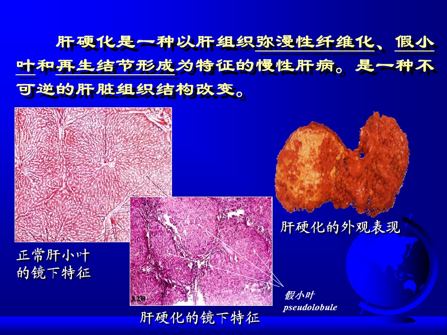 肝硬化教案.ppt_第3页