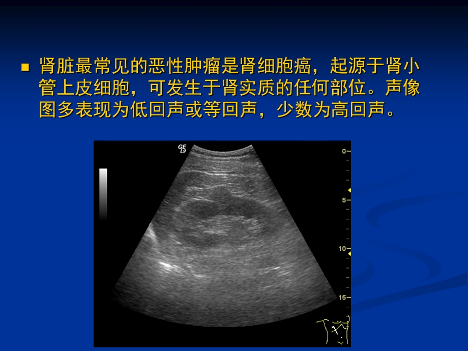 肾脏肿瘤及肿瘤样病变的超声诊断.ppt_第2页