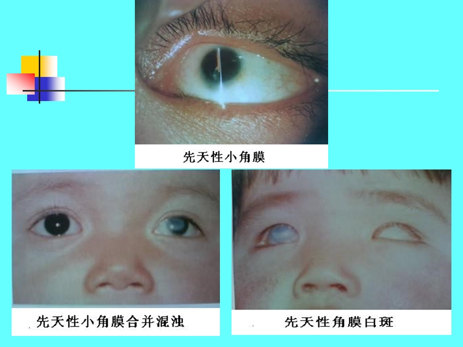 第五章角膜病与巩膜病.ppt_第3页