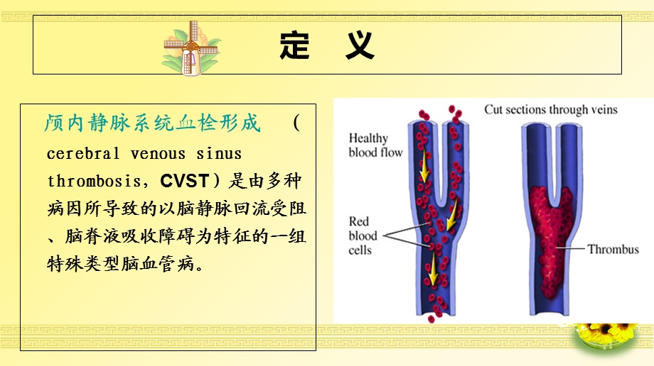 一例颅内静脉窦血栓形成病人的护理.ppt_第2页