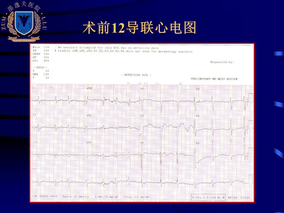 一例扩心合并房颤消融术后2年随访.ppt_第3页