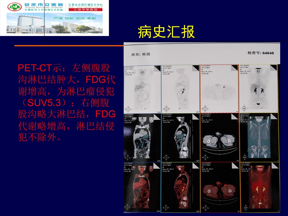 一例初诊难治MM的诊治-安庆立医院.ppt_第3页