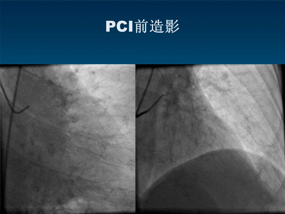 冠脉导丝引起冠脉小血管穿孔病例分析.ppt_第3页