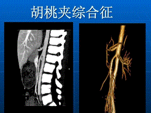 胡桃夹综合征.ppt.ppt