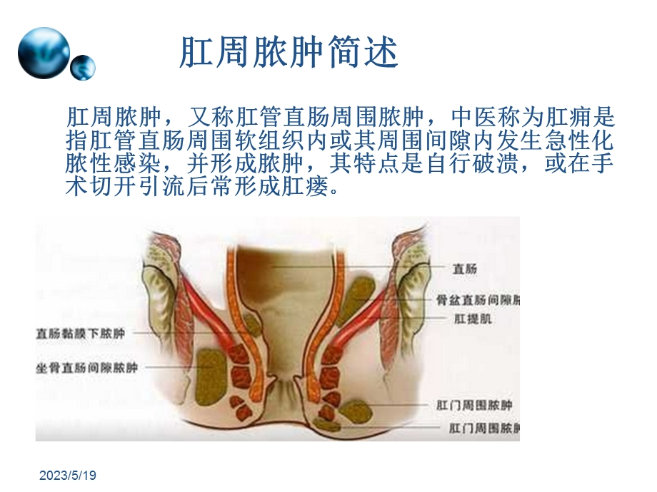 一例肛周脓肿术后换药个案.ppt_第3页