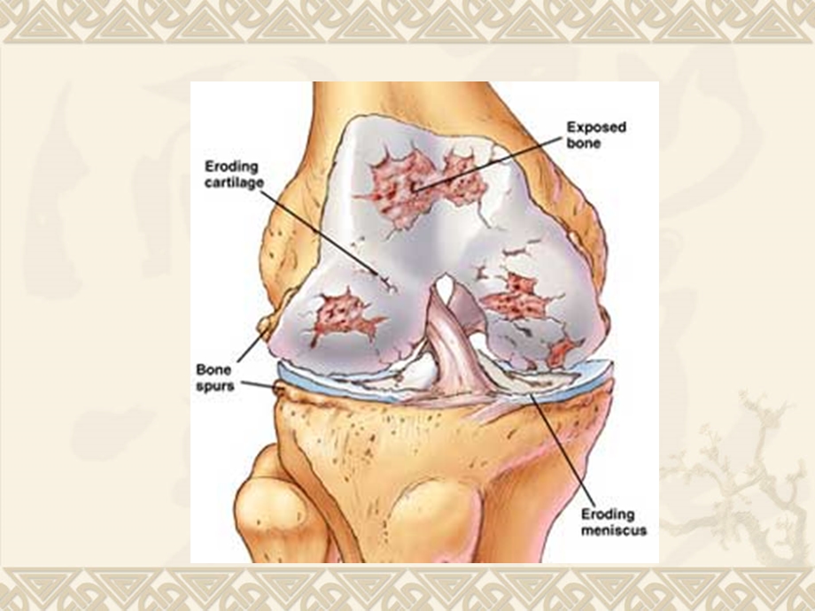 骨性关节炎徐王兵.ppt_第2页
