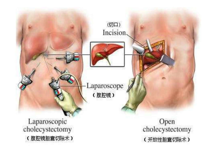 腹腔镜手术术前准备及术后护理.ppt_第3页