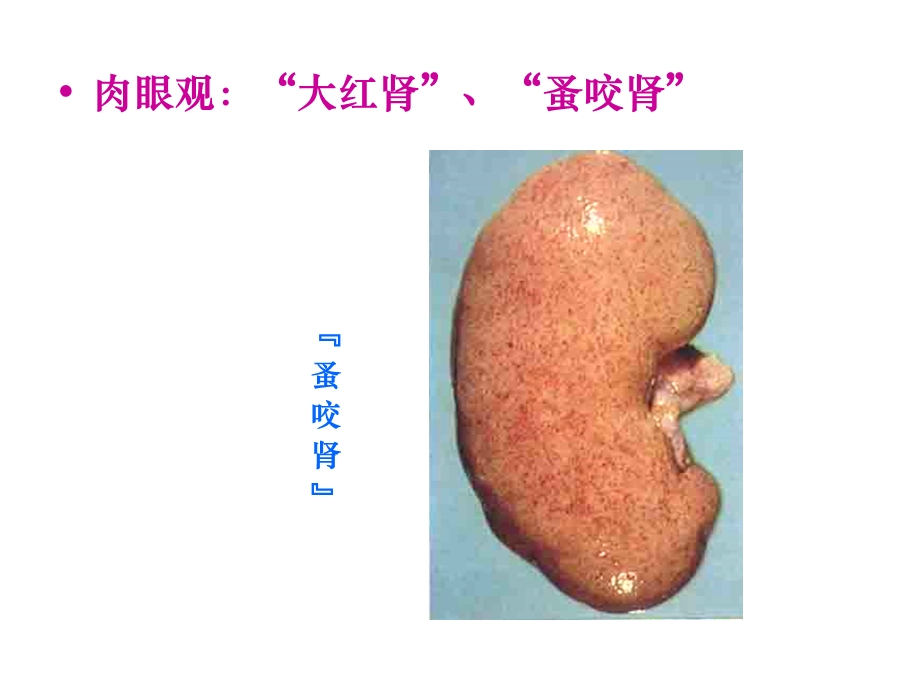 病理学肾小球肾炎(下部分).ppt_第2页