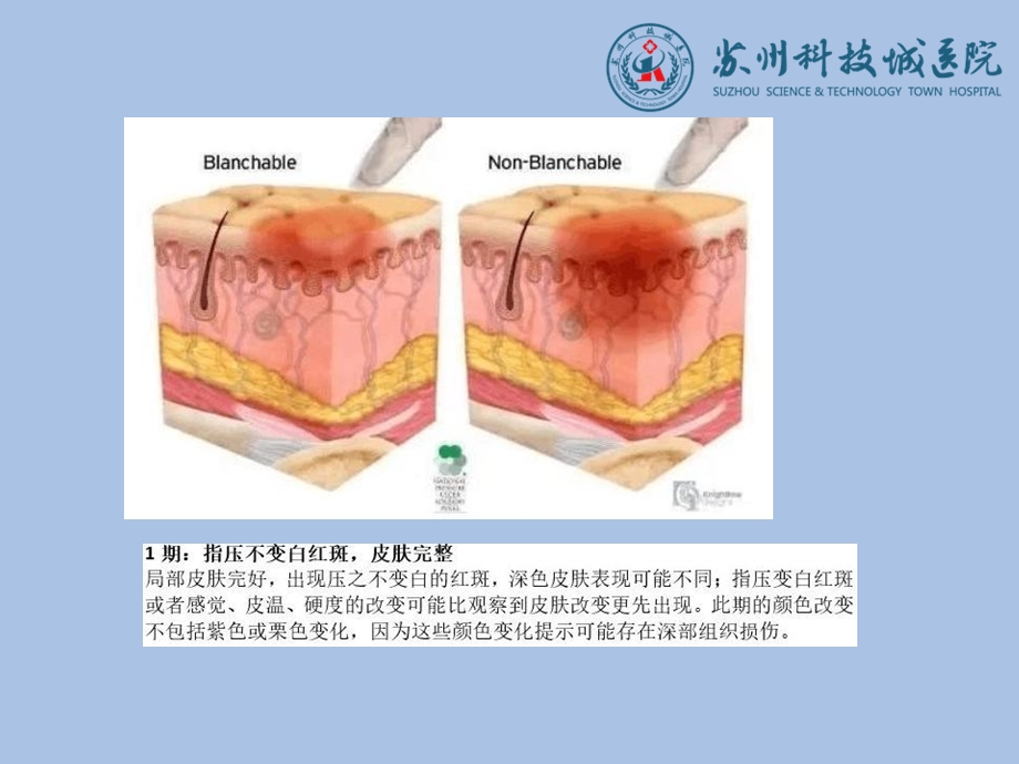 伤口敷料的选择及应用.ppt_第3页