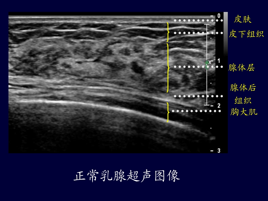 乳腺超声培训课件.ppt_第3页