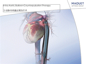 主动脉内球囊反搏术.ppt