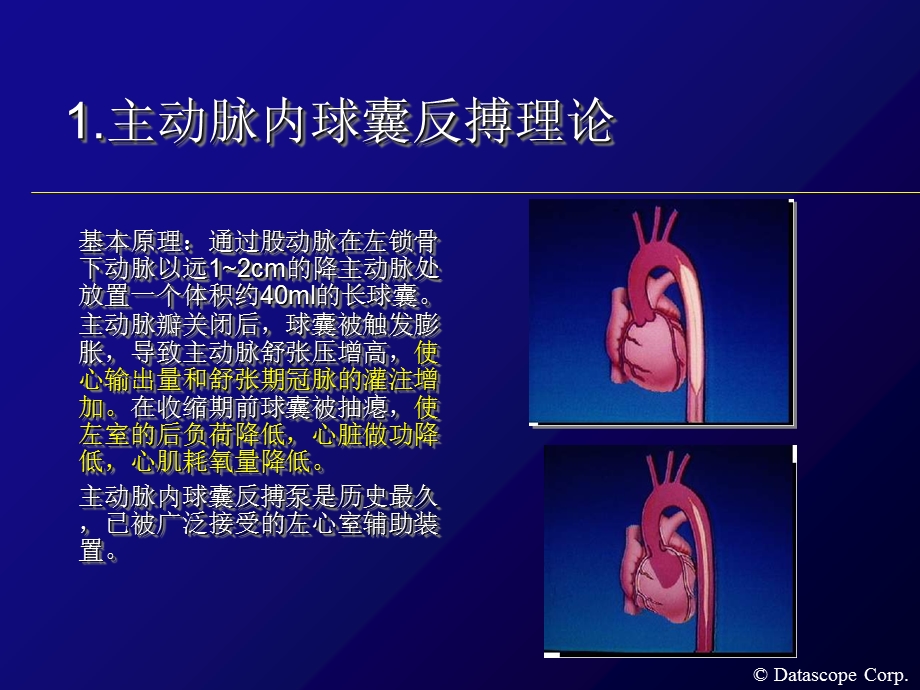 主动脉内球囊反搏泵的临床使用.ppt_第2页