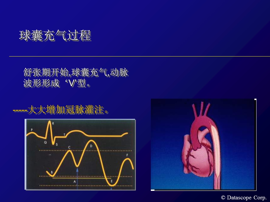 主动脉内球囊反搏泵的临床使用.ppt_第3页