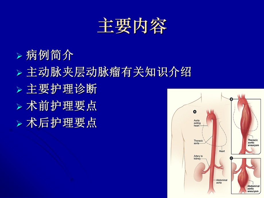 主动脉夹层动脉瘤围手术期教学查房.ppt_第2页