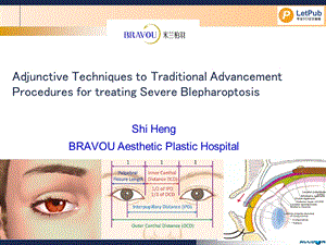 传统前徙步骤的附加技术矫正重度上睑下垂.ppt