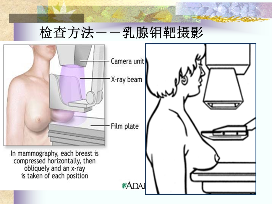 乳腺钙化的X线鉴别诊断.ppt_第3页