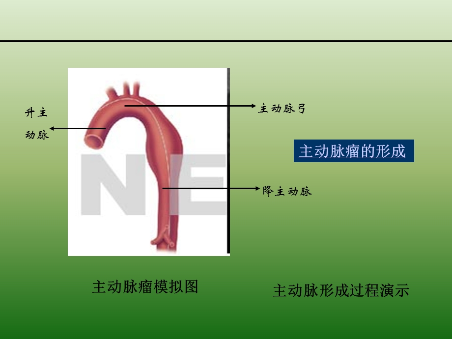 主动脉瘤和直管支架.ppt_第3页