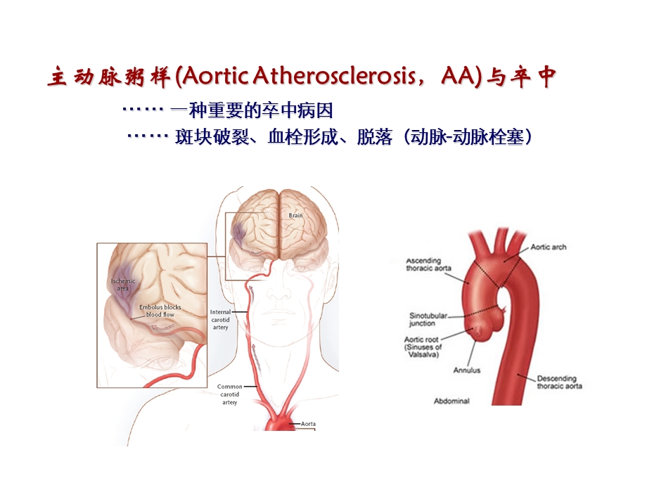 主动脉粥样硬化的诊断与治疗.ppt_第3页