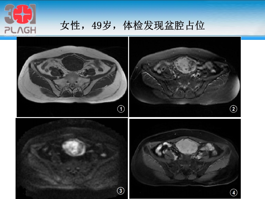 侵袭性纤维瘤病.ppt_第1页