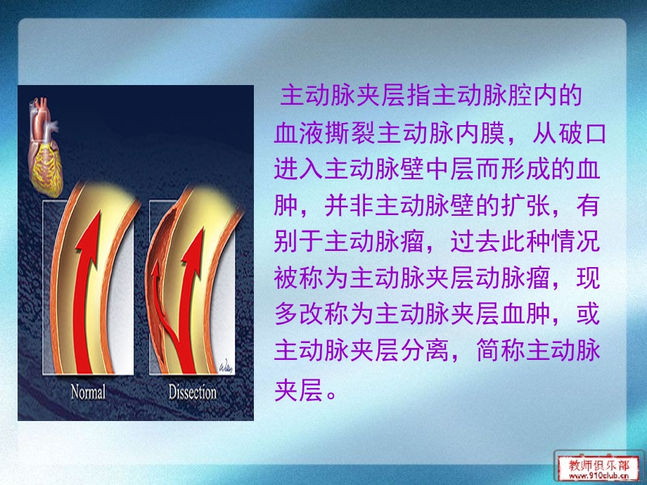 主动脉夹层的诊治.ppt_第2页