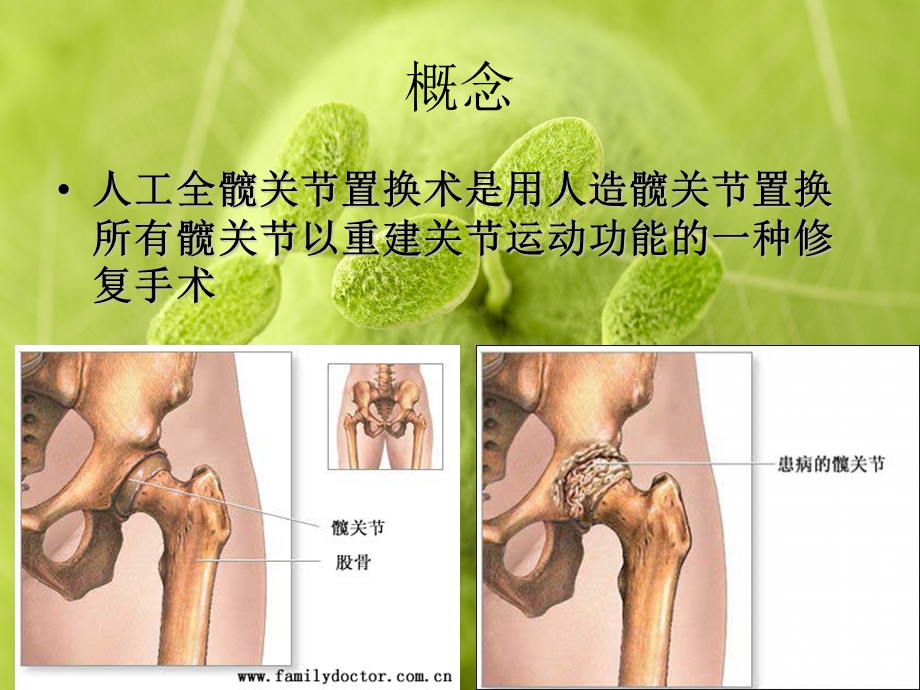 人工全髋关节置换术.ppt_第3页