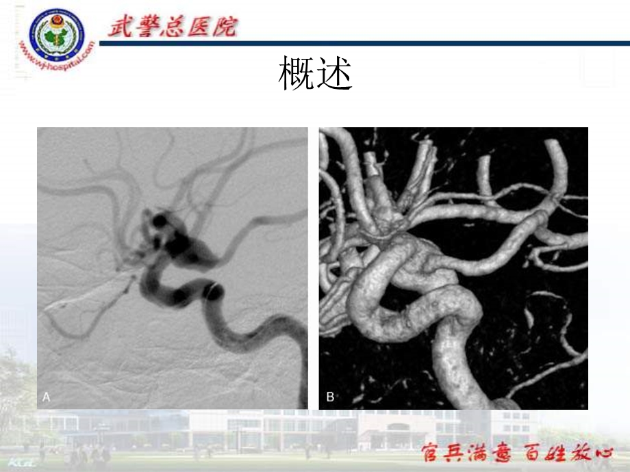 介入治疗带分支血管囊状动脉瘤.ppt_第3页