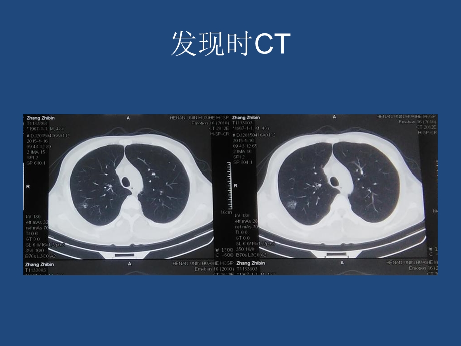 例肺ggn的诊疗历程.ppt_第3页