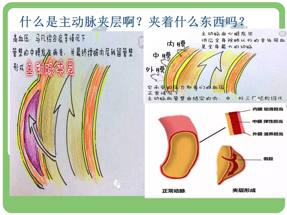 主动脉夹层的病例讨论.ppt_第3页